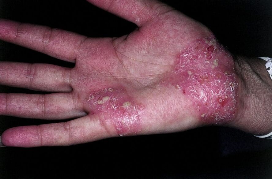 Aggravation du psoriasis sur les mains