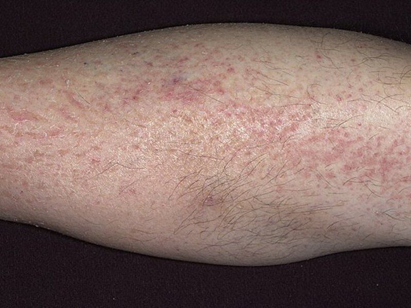 Symptômes du psoriasis sur les jambes