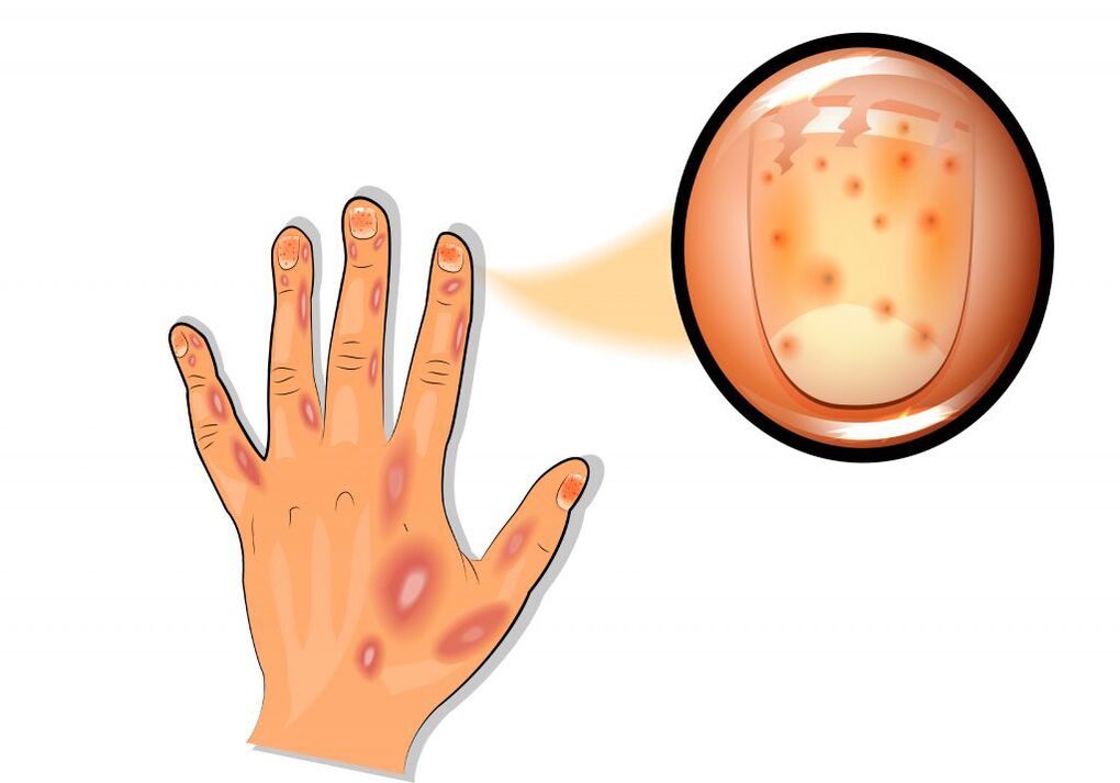 Dommages aux ongles dans le psoriasis