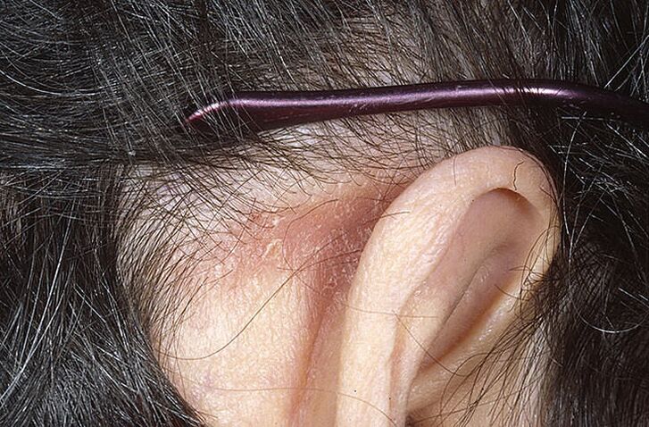 Plaque de psoriasis derrière l'oreille