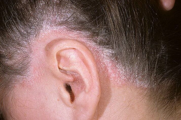 Poussées de psoriasis sur la tête derrière les oreilles