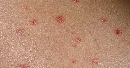 Plaques de psoriasis