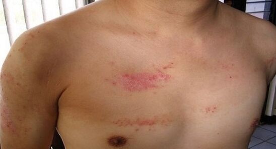 Psoriasis dans la poitrine