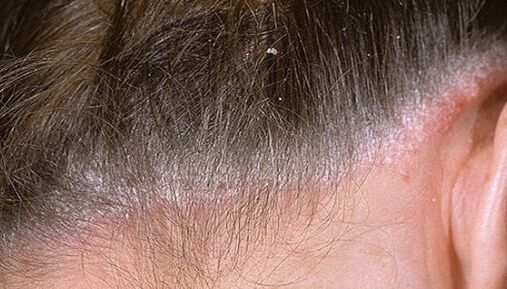 Psoriasis sur la tête