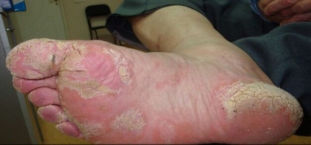 Psoriasis sur les pieds