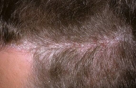 Psoriasis sur la tête