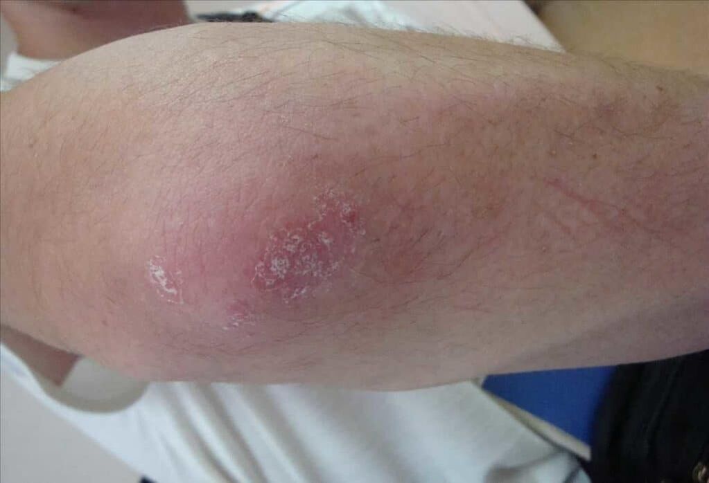 À quoi ressemble le psoriasis