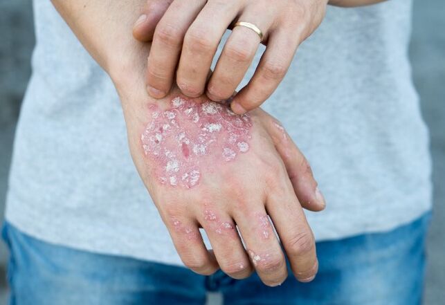 Psoriasis réprimé