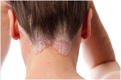 Psoriasis dans les cheveux