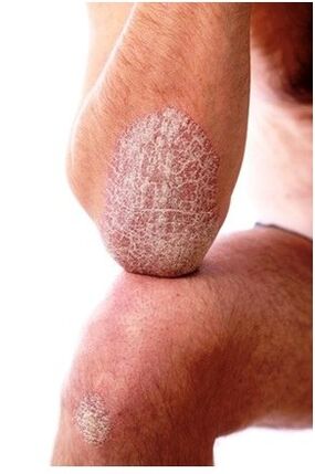 Psoriasis sur l'elbogène
