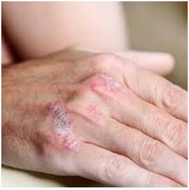Psoriasis sur le pinceau