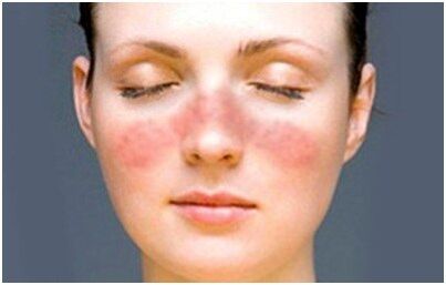 Psoriasis sur le visage