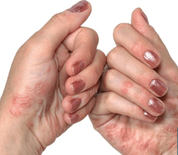Psoriasis entre les mains