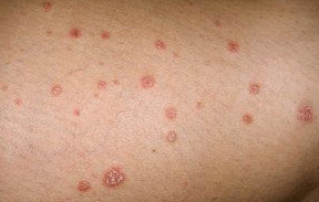 Plaques de psoriasis