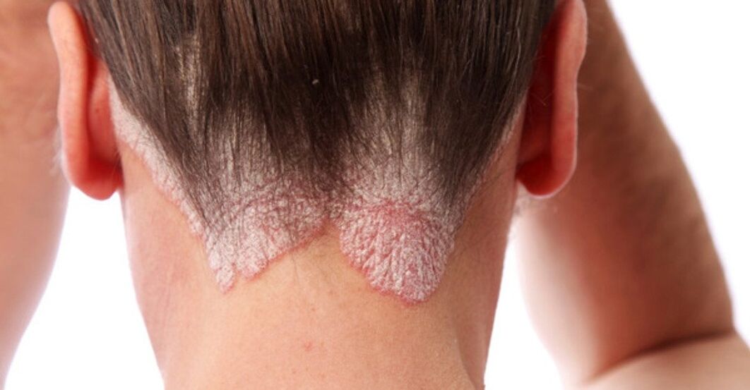 Psoriasis sur la tête de la fille