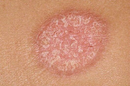 psoriasis