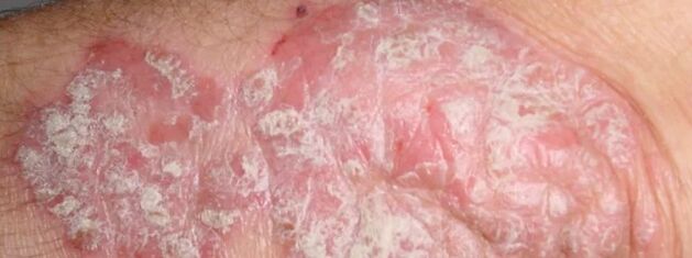 Psoriasis réprimé