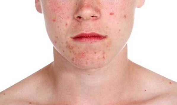 Symptômes du psoriasis