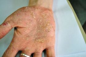 Psoriasis dans leur paume
