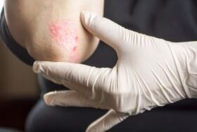 Psoriasis sur l'elbogène
