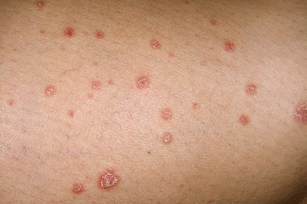 Plaques de psoriasis