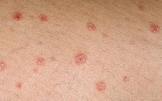 Le psoriasis aux premiers stades