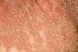 Psoriasis pustuleux