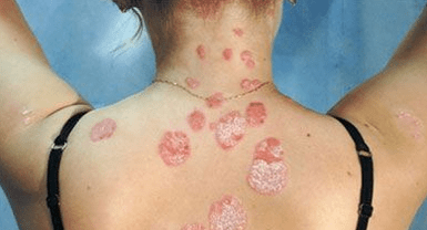 psoriasis