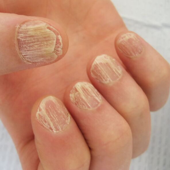 Dommages aux ongles causés par le psoriasis