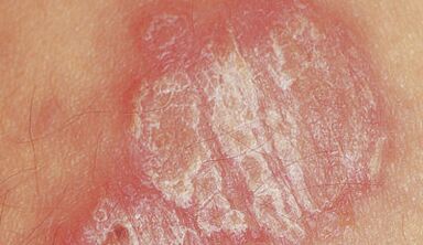 psoriasis