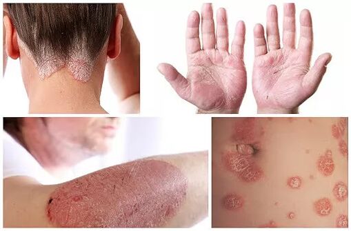Manifestations du psoriasis sur différentes parties du corps
