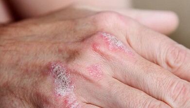 Symptômes du stade initial du psoriasis
