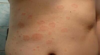 Comment reconnaître les premiers stades du psoriasis