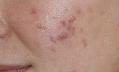 Symptômes du stade initial du psoriasis