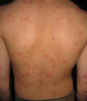 Psoriasis sur le dos
