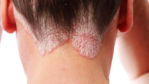 Plaques de psoriasis sur le cuir chevelu