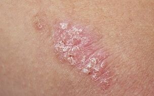 Causes du psoriasis