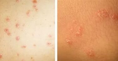 Principaux symptômes du psoriasis
