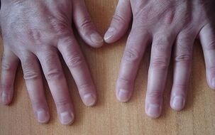 Symptômes du psoriasis aux premiers stades