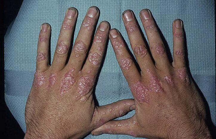 Raisons du développement du psoriasis sur les mains