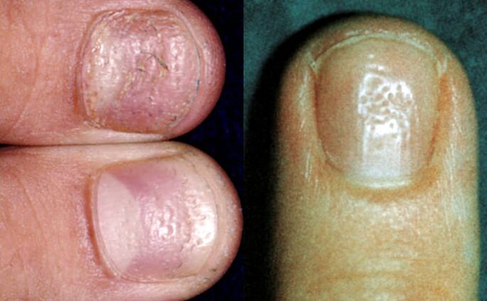 Symptôme de la digitale - plusieurs dépressions à la surface de la plaque de l'ongle